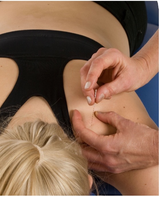 Dry needling-behandling med nål i rygg